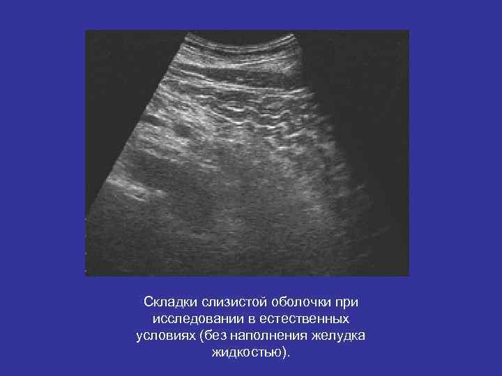 Складки слизистой оболочки при исследовании в естественных условиях (без наполнения желудка Складки слизистой оболочки при исследовании в естественных условиях (без наполнения желудка
