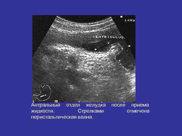 Антральный отдел желудка после приема жидкости. Стрелками отмечена перистальтическая волна. Антральный отдел желудка после приема жидкости. Стрелками отмечена перистальтическая волна.