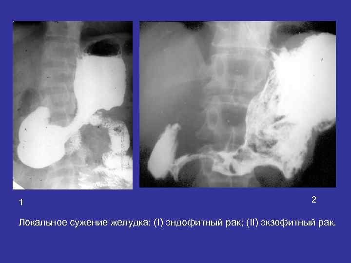 1 2 Локальное сужение желудка: (I) эндофитный рак; (II) экзофитный 1 2 Локальное сужение желудка: (I) эндофитный рак; (II) экзофитный
