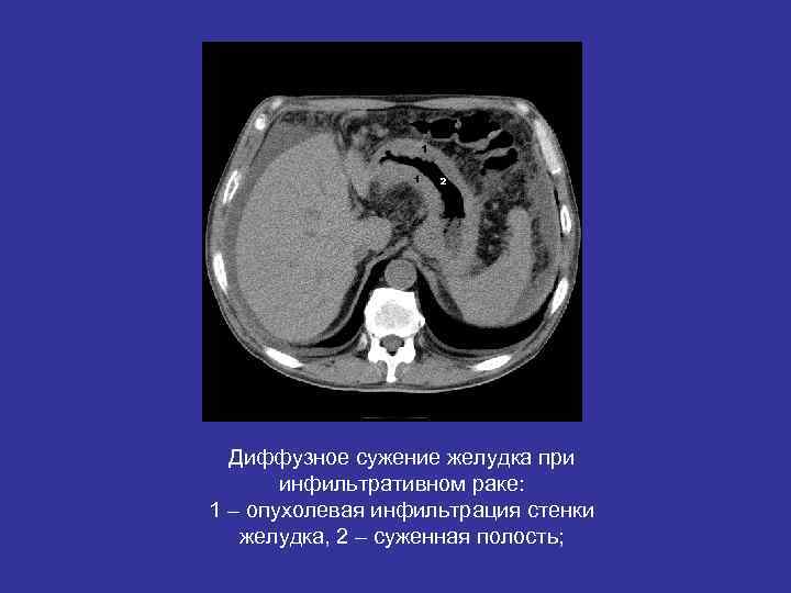 Диффузное сужение желудка при инфильтративном раке: 1 – опухолевая инфильтрация стенки Диффузное сужение желудка при инфильтративном раке: 1 – опухолевая инфильтрация стенки