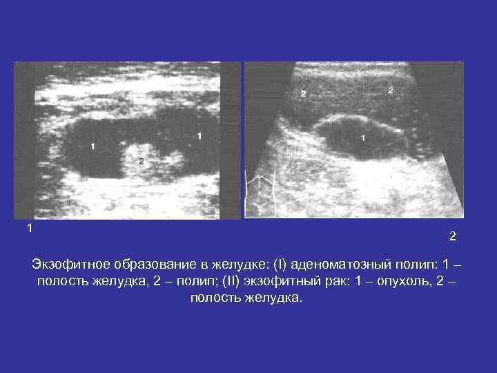 1 2 Экзофитное образование в желудке: (I) аденоматозный полип: 1 2 Экзофитное образование в желудке: (I) аденоматозный полип: