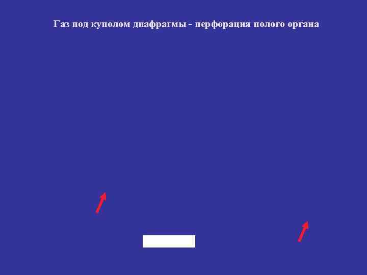 Газ под куполом диафрагмы - перфорация полого органа Газ под куполом диафрагмы - перфорация полого органа