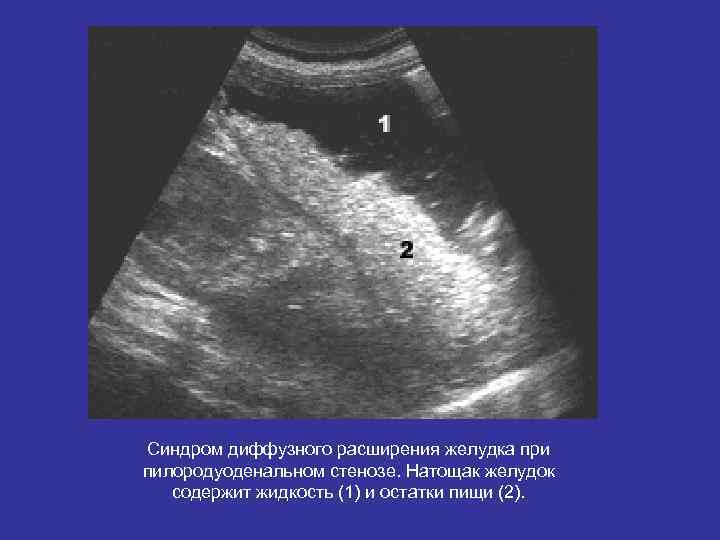 Синдром диффузного расширения желудка при пилородуоденальном стенозе. Натощак желудок содержит жидкость (1) и Синдром диффузного расширения желудка при пилородуоденальном стенозе. Натощак желудок содержит жидкость (1) и