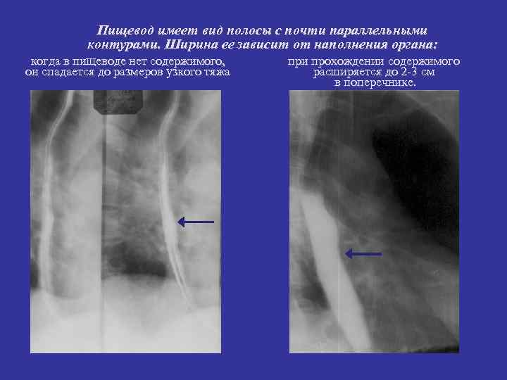 Пищевод имеет вид полосы с почти параллельными контурами. Ширина ее зависит Пищевод имеет вид полосы с почти параллельными контурами. Ширина ее зависит