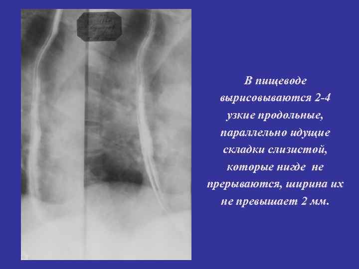 В пищеводе вырисовываются 2 -4 узкие продольные, параллельно идущие В пищеводе вырисовываются 2 -4 узкие продольные, параллельно идущие