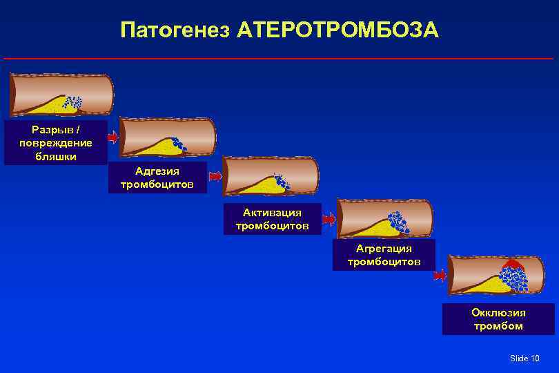    Патогенез АТЕРОТРОМБОЗА Разрыв / повреждение  бляшки   Адгезия 