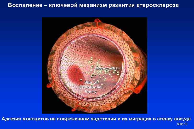  Воспаление – ключевой механизм развития атеросклероза Адгезия моноцитов на повреженном эндотелии и их