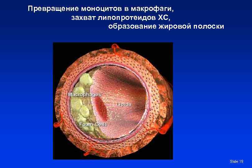 Превращение моноцитов в макрофаги,  захват липопротеидов ХС,    образование жировой полоски