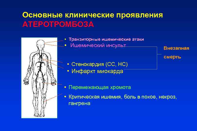 Основные клинические проявления АТЕРОТРОМБОЗА  • Транзиторные ишемические атаки  • Ишемический инсульт 
