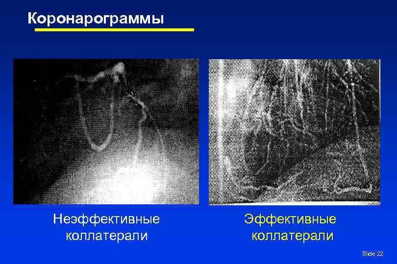 Коронарограммы  Неэффективные  Эффективные  коллатерали       Slide