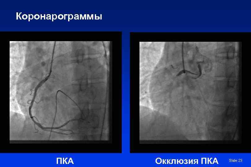 Коронарограммы  ПКА  Окклюзия ПКА  Slide 23 