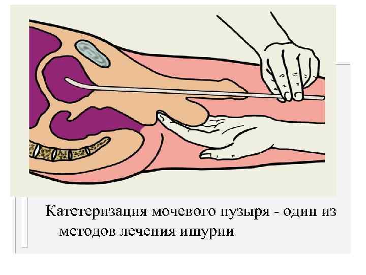 Катетеризация мочевого пузыря - один из  методов лечения ишурии 