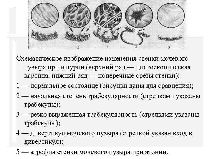 Трабекулярная стенка мочевого