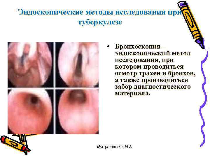 Эндоскопические методы исследования при    туберкулезе     • Бронхоскопия