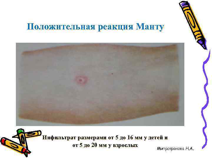 Положительная реакция Манту  Инфильтрат размерами от 5 до 16 мм у детей и