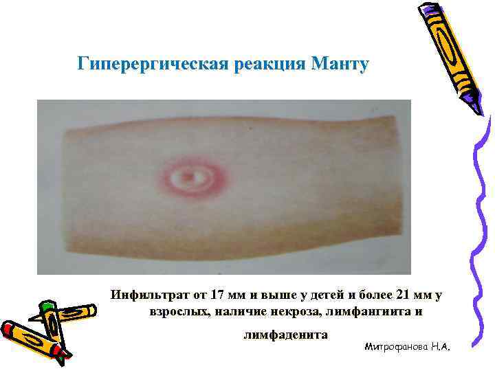 Гиперергическая реакция Манту  Инфильтрат от 17 мм и выше у детей и более
