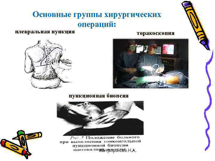  Основные группы хирургических    операций: плевральная пункция    