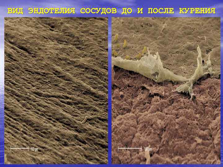 ВИД ЭНДОТЕЛИЯ СОСУДОВ ДО И ПОСЛЕ КУРЕНИЯ 
