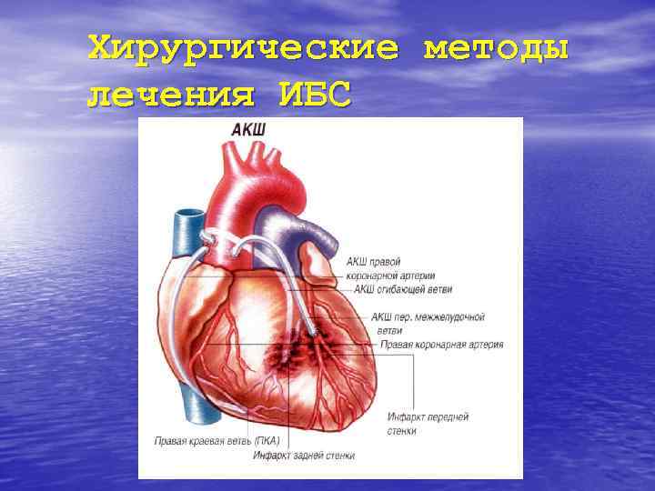 Хирургические методы лечения ИБС 