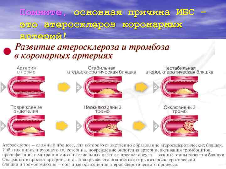 Помните, основная причина ИБС – это атеросклероз коронарных артерий! 
