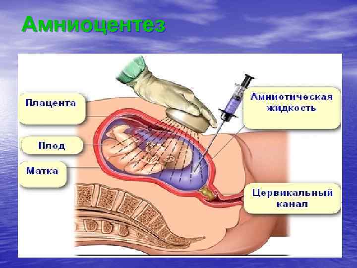 Амниоцентез 