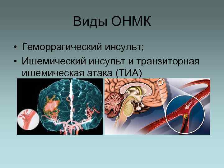   Виды ОНМК • Геморрагический инсульт;  • Ишемический инсульт и транзиторная 