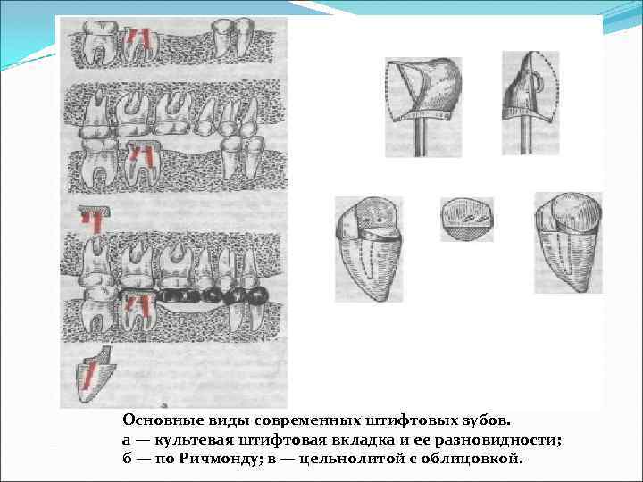 Штифтовый зуб по ричмонду