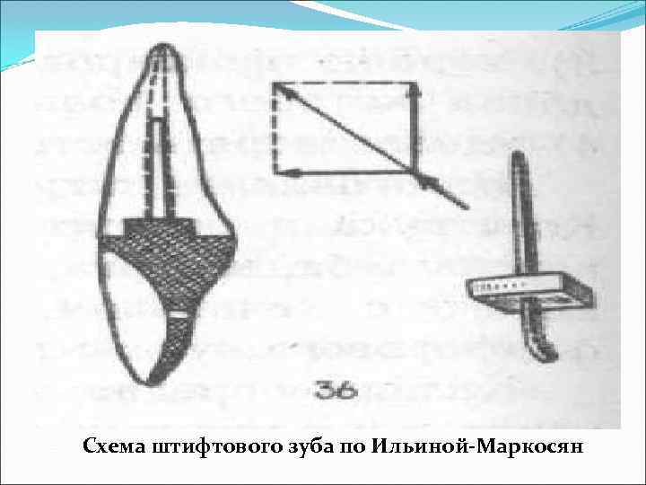 Штифтовые зубы презентация