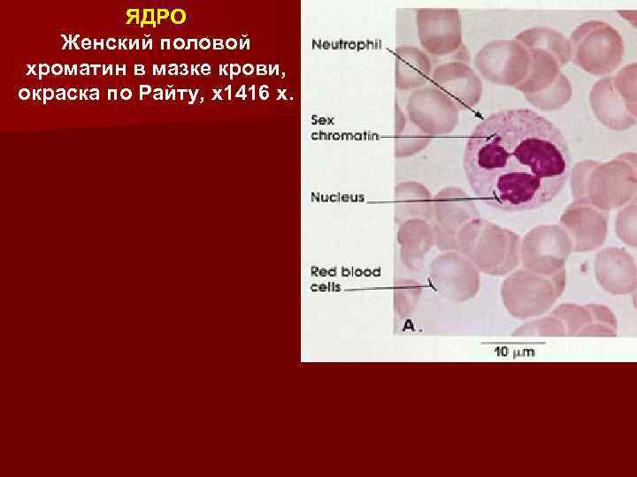 ЯДРО Женский половой хроматин в мазке крови, окраска по Райту, х1416 x. 