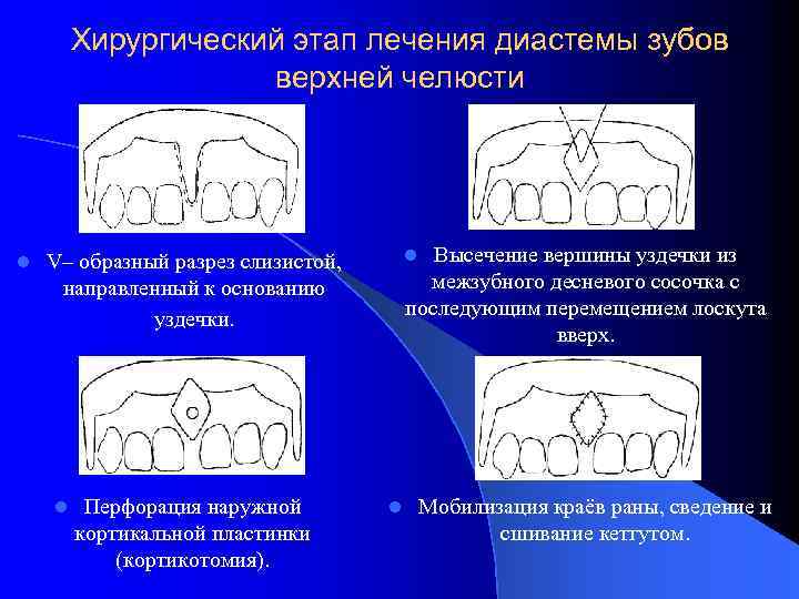 Хирургический этап лечения диастемы зубов верхней челюсти l Высечение вершины уздечки из межзубного десневого