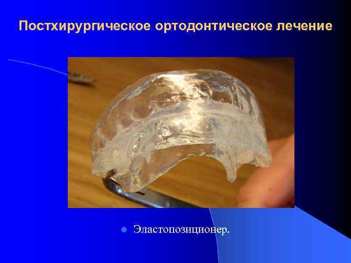 Постхирургическое ортодонтическое лечение l Эластопозиционер. 