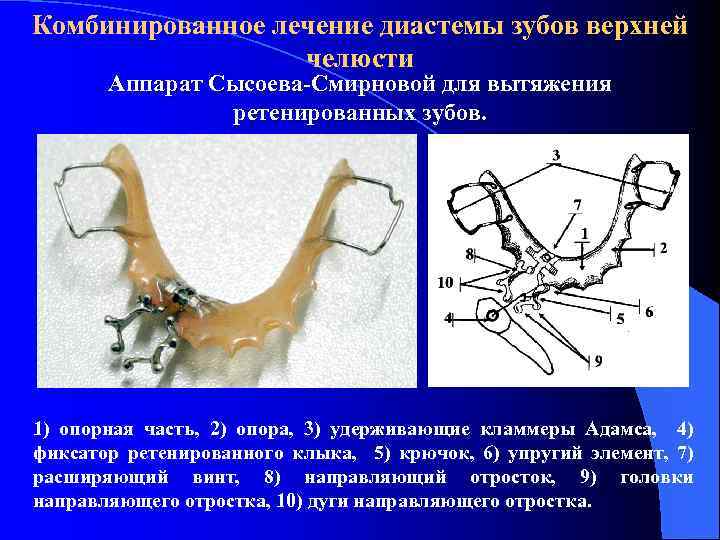 Комбинированное лечение диастемы зубов верхней челюсти Аппарат Сысоева-Смирновой для вытяжения ретенированных зубов. 1) опорная