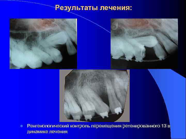 Результаты лечения: l Ренгенологический контроль перемещения ретенированного 13 в динамике лечения 