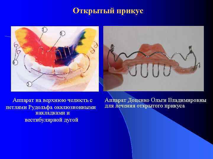 Открытый прикус Аппарат на верхнюю челюсть с петлями Рудольфа окклюзионными накладками и вестибулярной дугой