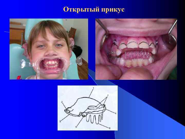 Открытый прикус 