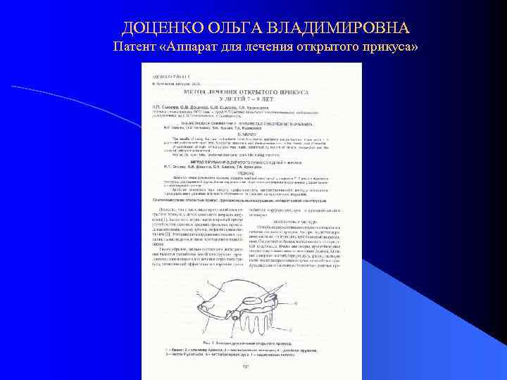 ДОЦЕНКО ОЛЬГА ВЛАДИМИРОВНА Патент «Аппарат для лечения открытого прикуса» 
