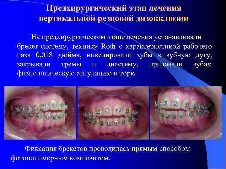 Предхирургический этап лечения вертикальной резцовой дизокклюзии На предхирургическом этапе лечения устанавливали брекет-систему, технику Roth