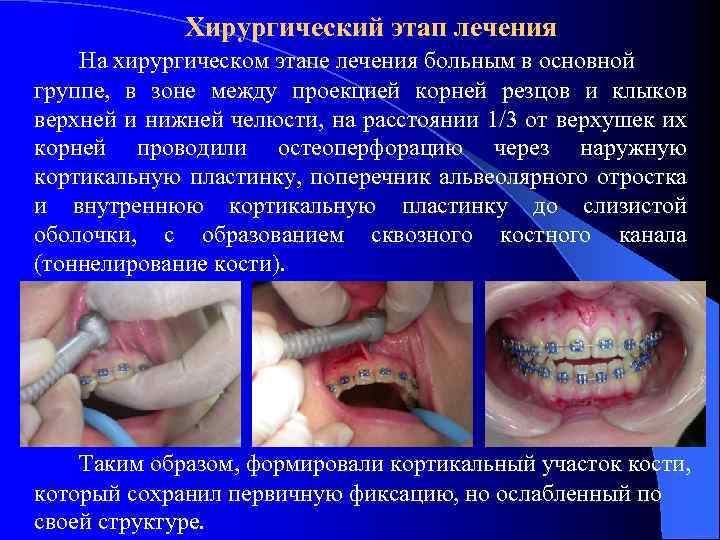 Хирургический этап лечения На хирургическом этапе лечения больным в основной группе, в зоне между