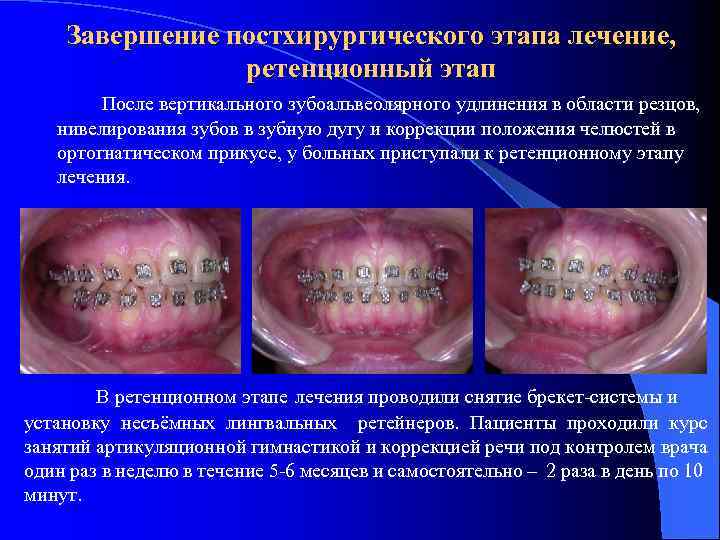 Завершение постхирургического этапа лечение, ретенционный этап После вертикального зубоальвеолярного удлинения в области резцов, нивелирования