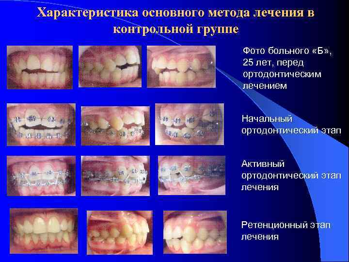 Характеристика основного метода лечения в контрольной группе Фото больного «Б» , 25 лет, перед