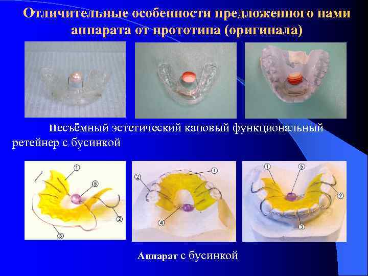 Отличительные особенности предложенного нами аппарата от прототипа (оригинала) Несъёмный эстетический каповый функциональный ретейнер с