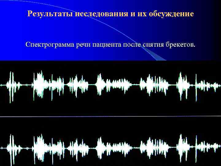 Результаты исследования и их обсуждение Спектрограмма речи пациента после снятия брекетов. 