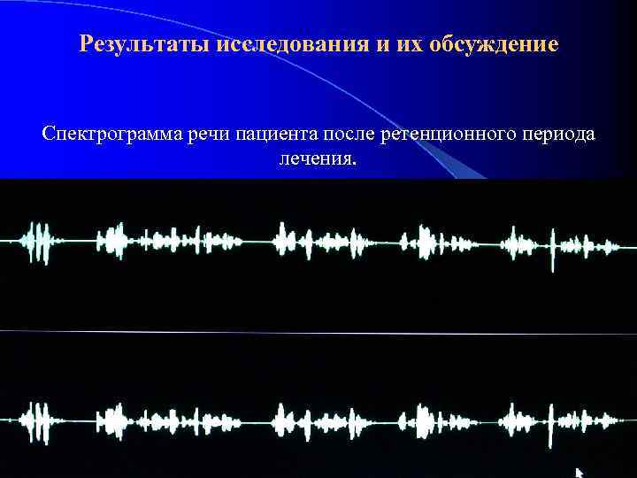 Результаты исследования и их обсуждение Спектрограмма речи пациента после ретенционного периода лечения. 