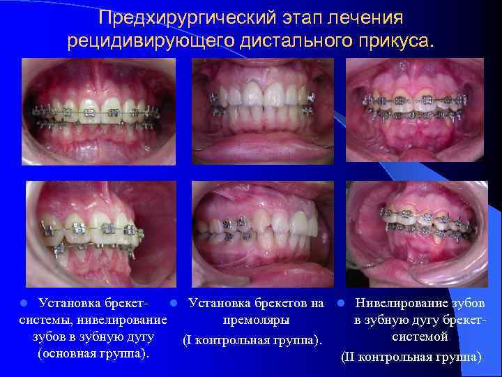 Предхирургический этап лечения рецидивирующего дистального прикуса. Установка брекетl Установка брекетов на l Нивелирование зубов