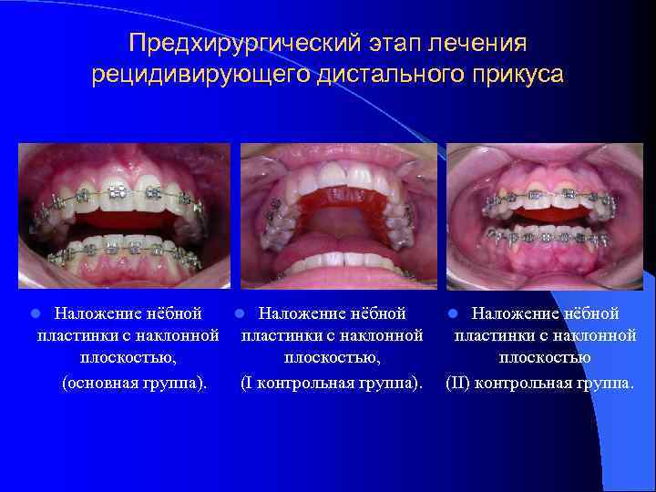 Предхирургический этап лечения рецидивирующего дистального прикуса Наложение нёбной l Наложение нёбной пластинки с наклонной