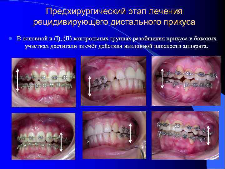 Предхирургический этап лечения рецидивирующего дистального прикуса l В основной и (I), (II) контрольных группах
