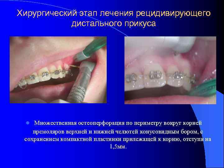 Хирургический этап лечения рецидивирующего дистального прикуса Множественная остеоперфорация по периметру вокруг корней премоляров верхней