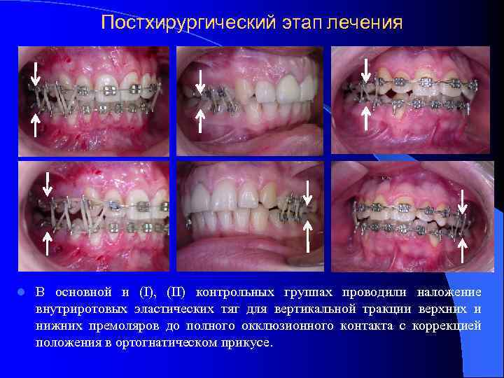 Постхирургический этап лечения l В основной и (I), (II) контрольных группах проводили наложение внутриротовых