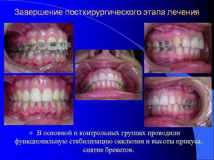 Завершение постхирургического этапа лечения В основной и контрольных группах проводили функциональную стабилизацию окклюзии и