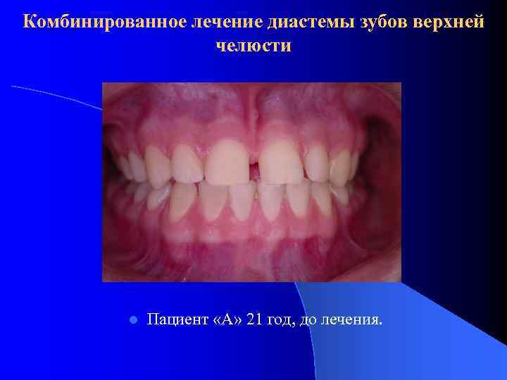 Комбинированное лечение диастемы зубов верхней челюсти l Пациент «А» 21 год, до лечения. 
